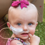 infant with a nasal gastric tube looks at camera